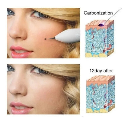 DermoPlasma Pro:🔥 ¡Elimina imperfecciones desde casa como una profesional!