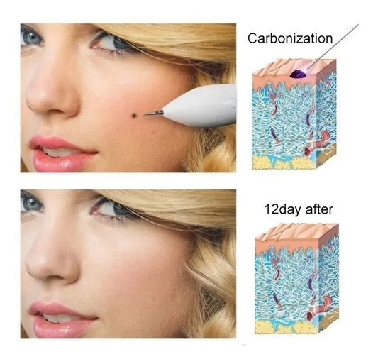 DermoPlasma Pro:🔥 ¡Elimina imperfecciones desde casa como una profesional!